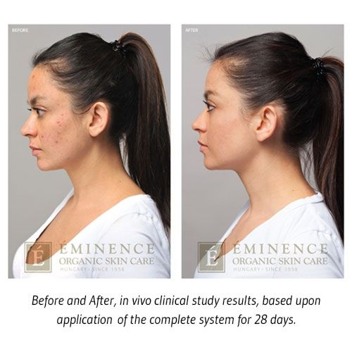 Eminence Organics Acne Advanced Treatment System - Image 3